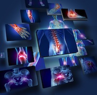 sglt2 inhibitors get stronger warnings regarding bone fractures