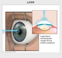 new attention being focused on side effects of lasik surgery