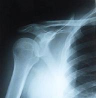 shoulder pain pump x-ray